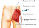 Защемление нерва в пояснице