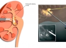 Дробление камней в почках Методы, видео