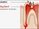 Пульпит