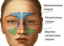 Острый гайморит: симптомы. Лечение острого гайморита