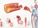 Атеросклероз - симптомы, причины, основные стадии, формы атеросклероз, диагностика, виды лечения атероскле