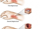 Ожоги: площадь ожогов, определения по правилу ладони. Классификация ожогов по площади и степени поражения