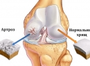 Как и где лечить артроз суставов?