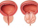 Диагностика простатита у мужчин - что нужно знать?