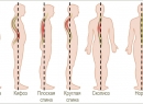 Искривление позвоночника