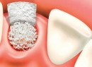 Костная пластика при имплантации зубов: отзывы