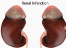 Инфаркт почки: причины, симптомы и лечение