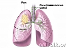 Народные методы лечения рака легких