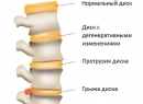 Протрузия