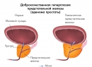 Народные методы лечения аденомы простаты