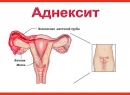 Аднексит