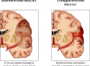 Инфаркт головного мозга