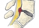 Дорзальная грыжа диска: что это такое, классификация и особенности лечения