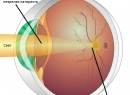 Катаракта - симптомы и лечение
