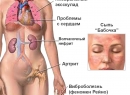 Волчанка - симптомы и описание аутоиммунного заболевания