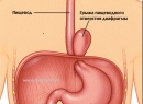 Грыжа пищевода