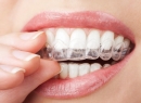 Инвизилайн, методика Invisalign – прозрачные капы - гигиена и эстетика, invisalign, методика інвізилайн, прозрачные капы