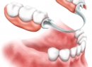 Съемное протезирование зубов - протезы и импланты, бюгельный протез, съемное протезирование