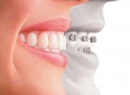 Украшения зубов – уникальная улыбка - гигиена и эстетика, зубы, драгоценности, украшения, скайсы