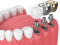 Имплантация нижних зубов