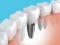 Симптомы отторжения зубных имплантов